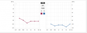 老年性聋需及时佩戴助听器(图1)